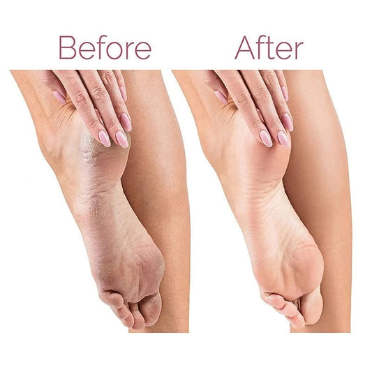 Electric Pedicure Foot File Callus Remover – Rechargeable Foot Care Tool